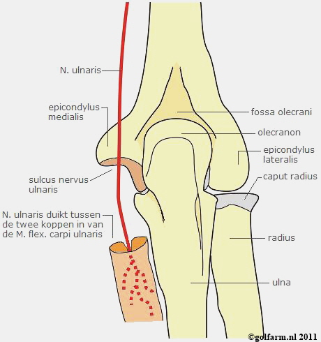 Cubitaal tunnelsyndroom -