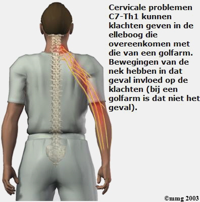 Ter ere van Kaarsen Bewijzen Differentiaal diagnose - Golfarm