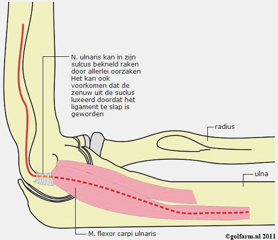 studio Strak Integreren Cubitaal tunnelsyndroom - Golfarm